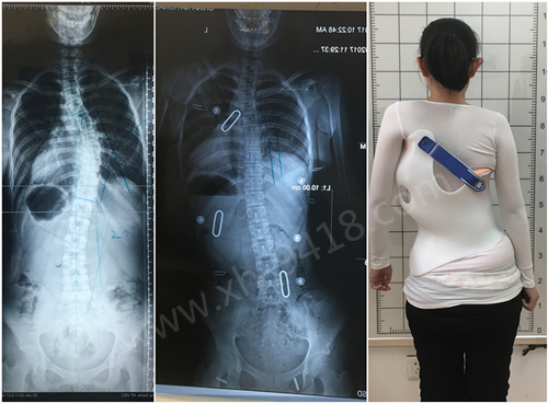 德国GBW侧弯支具病例20170225北京 之二-复查 GBW脊柱侧弯支具矫正案例 第1张