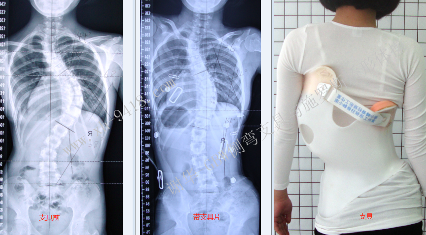 重度脊柱侧弯使用GBW支具矫形的复查病例（20180406） GBW脊柱侧弯支具矫正案例 第1张
