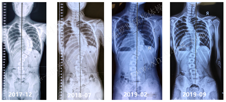 重度脊柱侧弯使用GBW支具矫形的复查病例（20180406） GBW脊柱侧弯支具矫正案例 第4张