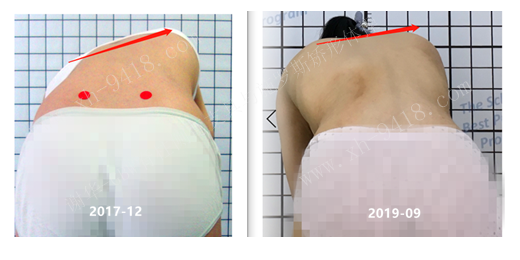 重度脊柱侧弯使用GBW支具矫形的复查病例（20180406） GBW脊柱侧弯支具矫正案例 第6张