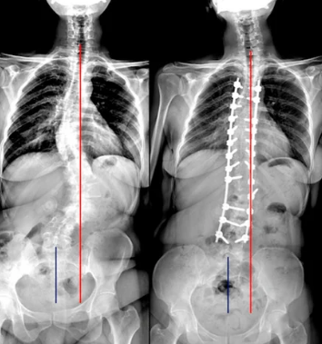 脊柱侧弯选择保守治疗还是手术？ 侧弯支具相关文章 第2张