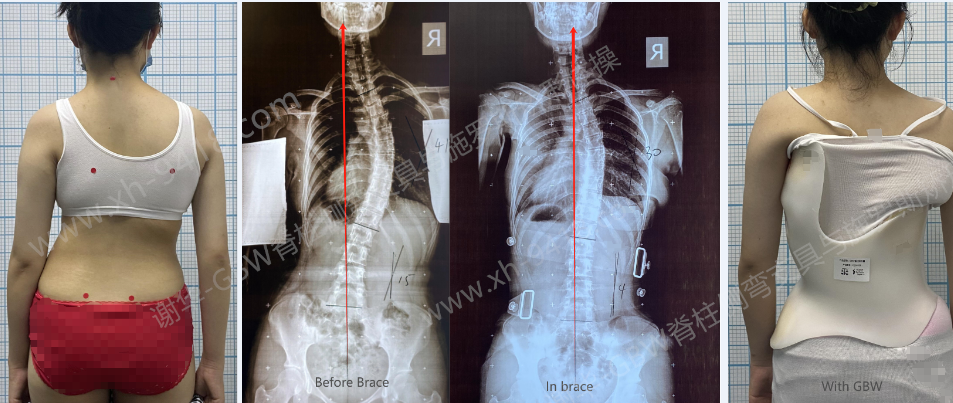 GBW支具案例-坚持就会有改变20240615    GBW脊柱侧弯支具矫正案例 第1张