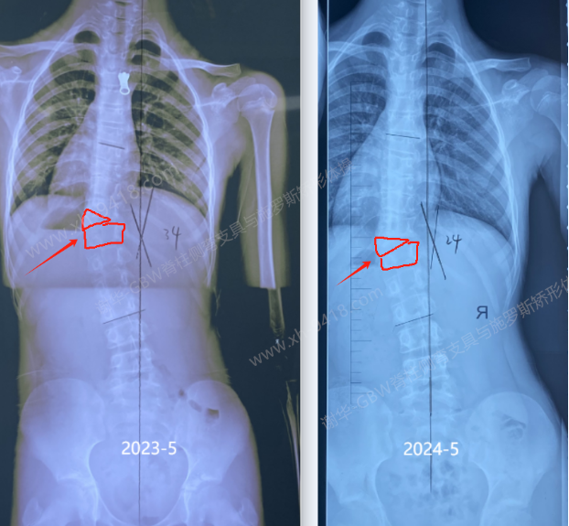 先天性侧弯改善案例20240628    GBW脊柱侧弯支具矫正案例 第2张