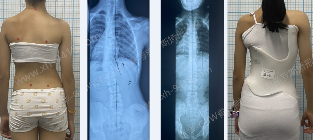 先天性侧弯改善案例20240628    GBW脊柱侧弯支具矫正案例 第5张