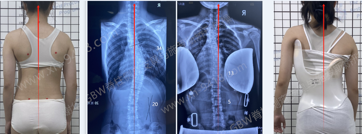 用施罗斯体操提高支具的矫正率 GBW脊柱侧弯支具矫正案例 第2张