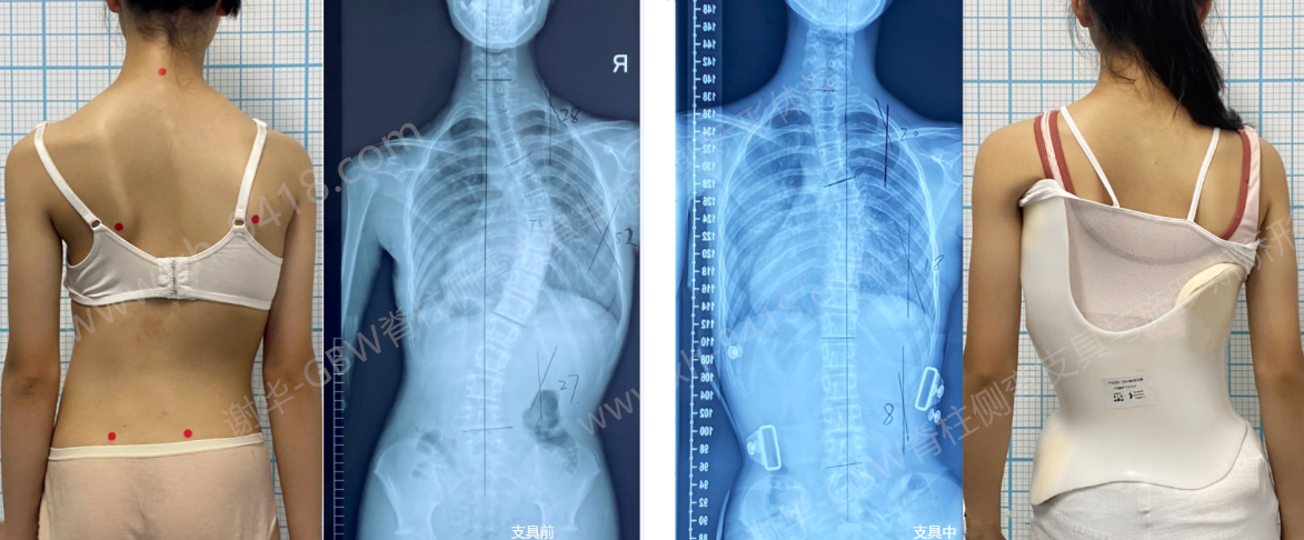 GBW支具案例20240823-胸弯52°的短期改善 GBW脊柱侧弯支具矫正案例 第1张