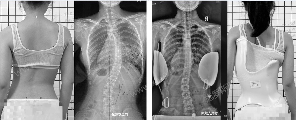 侧弯怎么都是胸右弯？ 侧弯支具相关文章 第2张