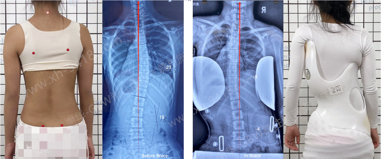 GBW支具案例20241014-支具内“过矫”恢复更快    GBW脊柱侧弯支具矫正案例 第1张