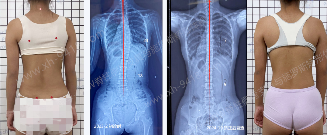 GBW支具案例20241014-支具内“过矫”恢复更快    GBW脊柱侧弯支具矫正案例 第2张