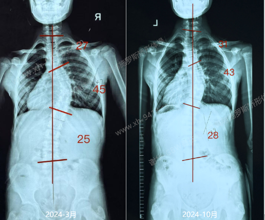 GBW支具案例20241123-从实例来看选择GBW支具的优势 GBW脊柱侧弯支具矫正案例 第3张