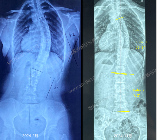 GBW支具案例20241123-从实例来看选择GBW支具的优势 GBW脊柱侧弯支具矫正案例 第1张