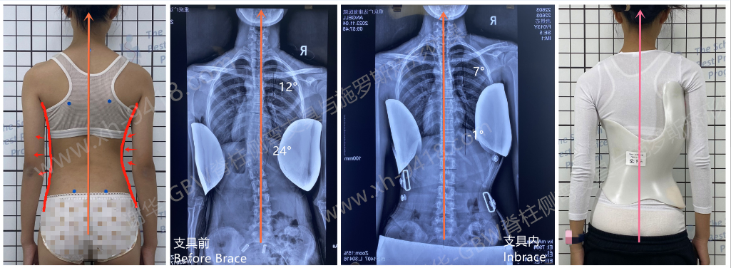 GBW支具案例20240615-轻度侧弯有加重趋势要尽早矫正 GBW脊柱侧弯支具矫正案例 第1张