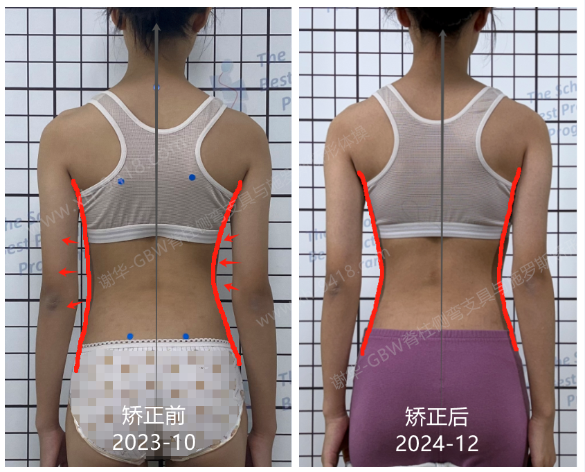 GBW支具案例20240615-轻度侧弯有加重趋势要尽早矫正 GBW脊柱侧弯支具矫正案例 第3张