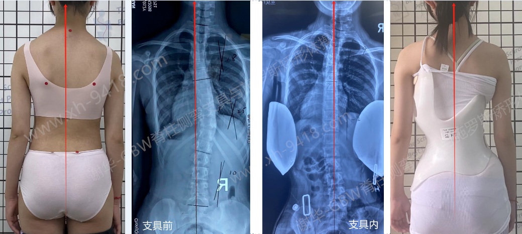 GBW支具案例20241226——12岁女孩的侧弯改善 GBW脊柱侧弯支具矫正案例 第1张