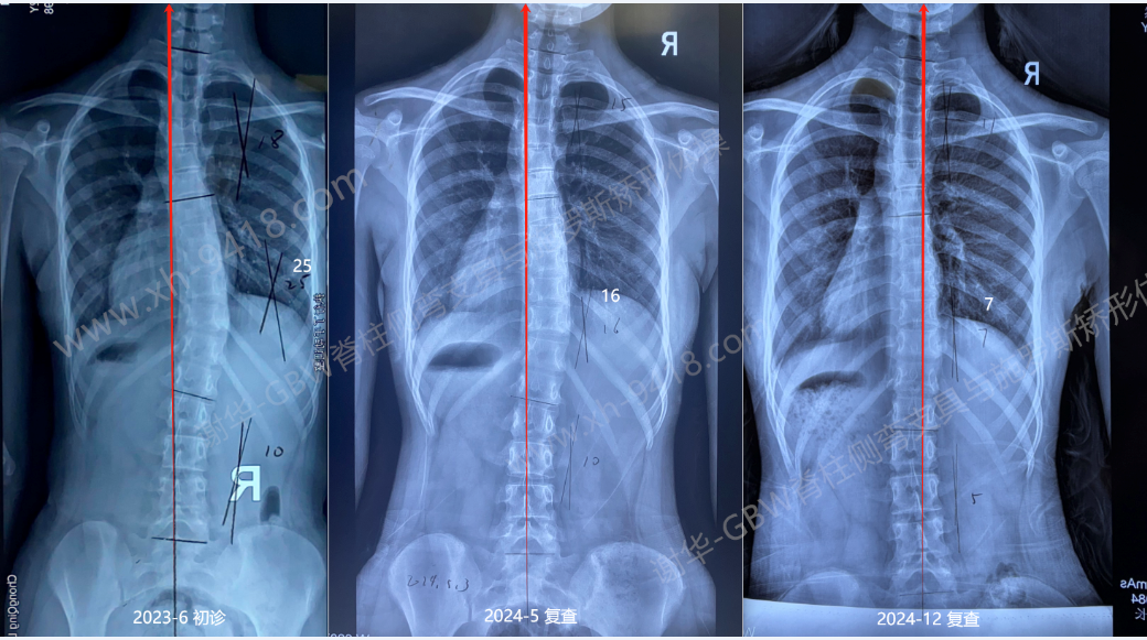 GBW支具案例20241226——12岁女孩的侧弯改善 GBW脊柱侧弯支具矫正案例 第2张