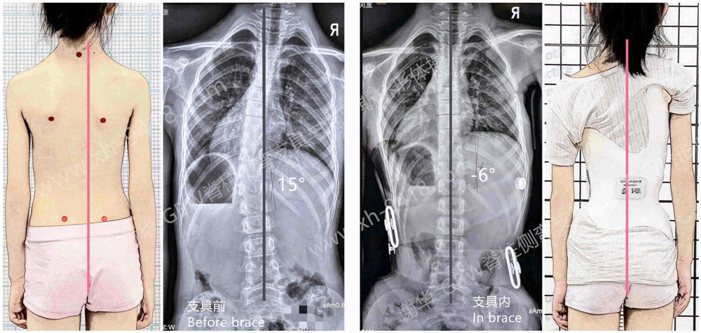 GBW支具案例20250906-很少见的胸左弯矫正 GBW脊柱侧弯支具矫正案例 第1张