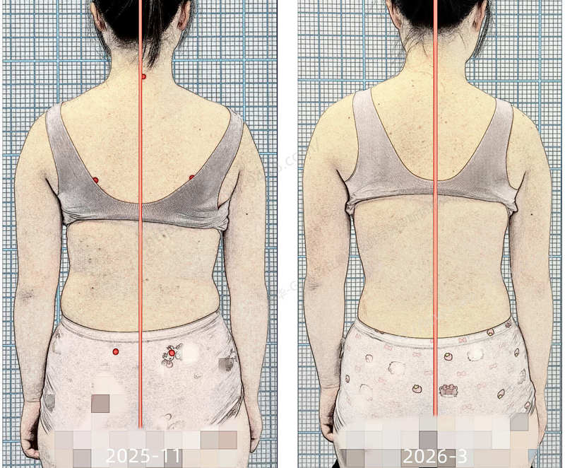 GBW支具案例20260315-进展中的侧弯要及时矫正 GBW脊柱侧弯支具矫正案例 第2张